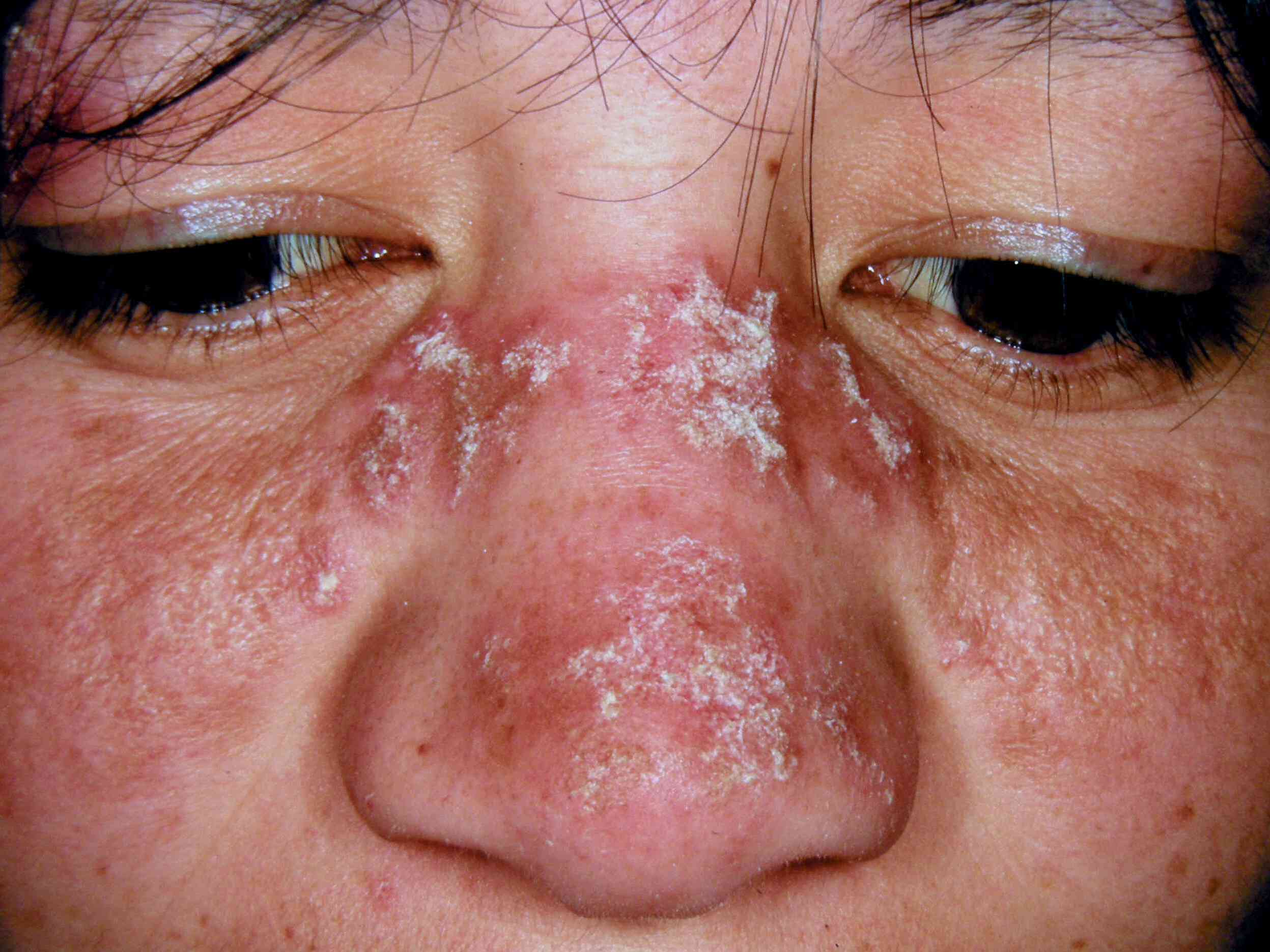 50-facts-about-discoid-lupus-erythematosus