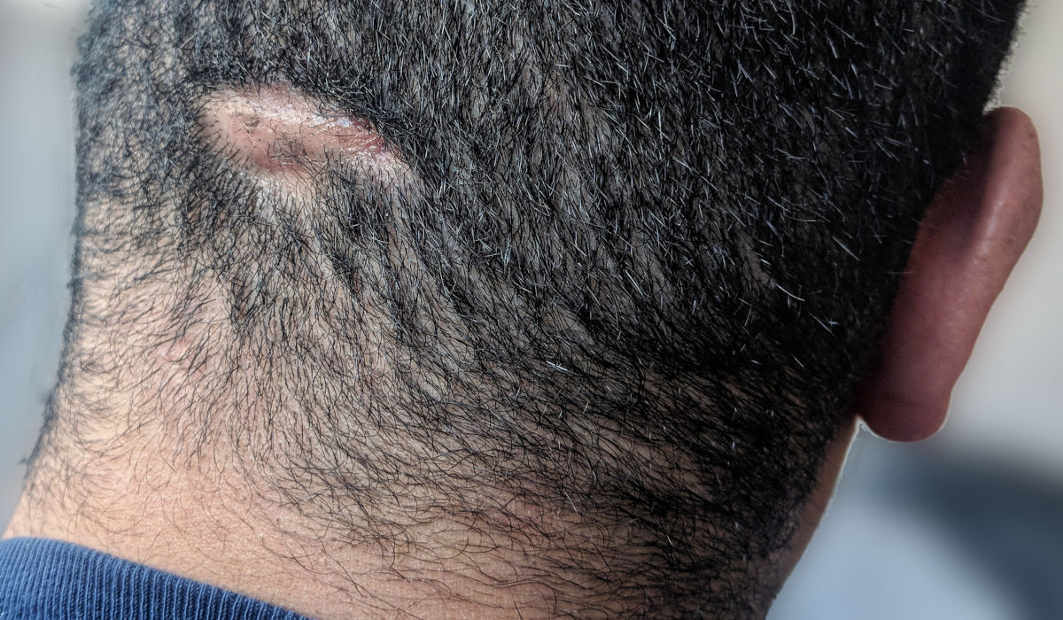 50-facts-about-dissecting-cellulitis-of-the-scalp