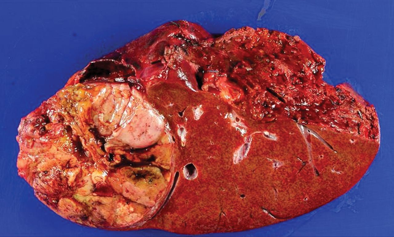 50-facts-about-hepatocellular-carcinoma