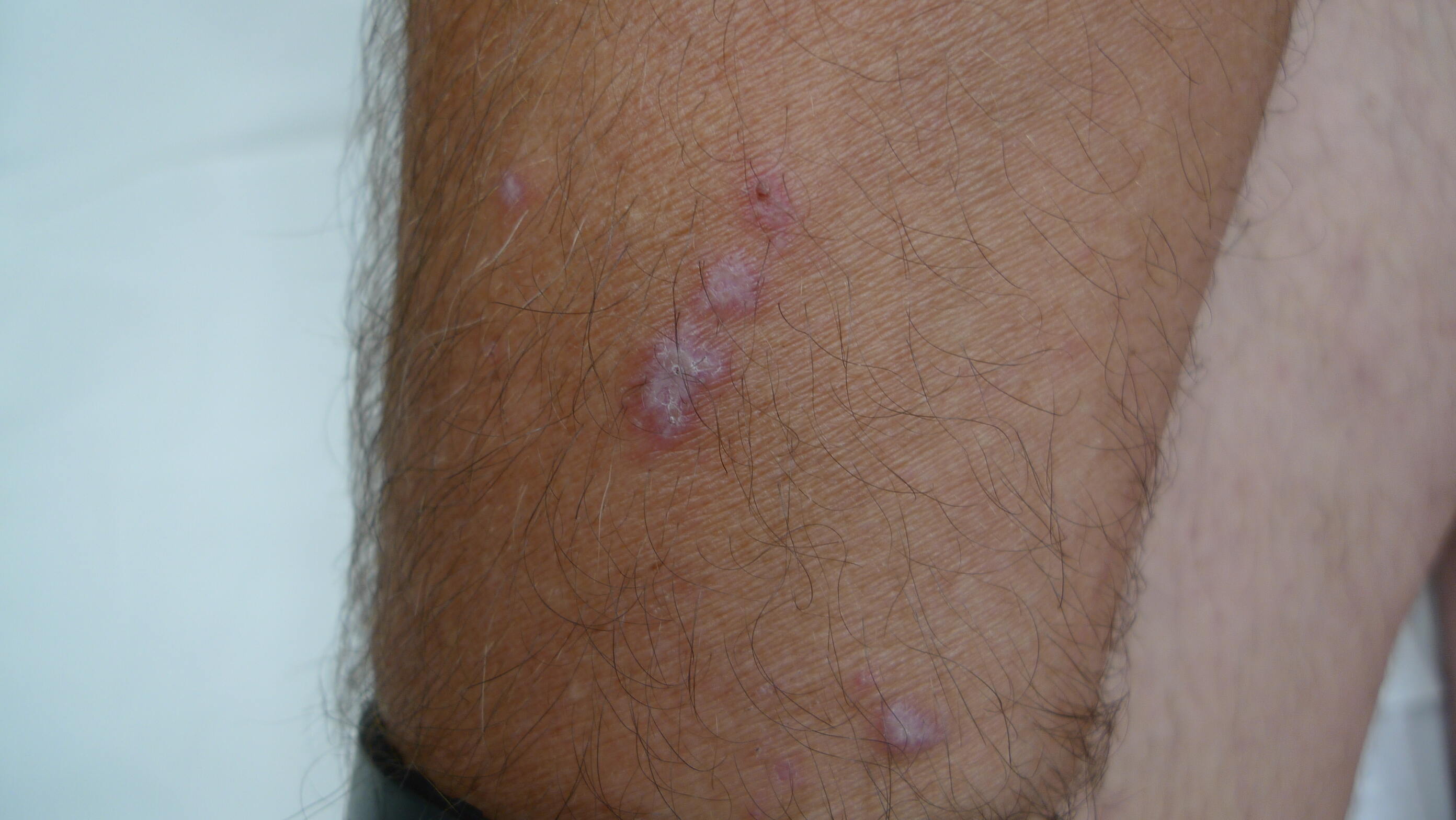 50-facts-about-lichen-planus