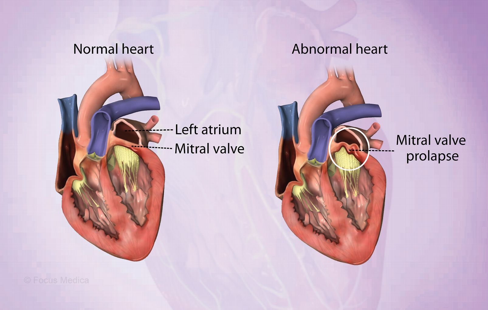 50-facts-about-mitral-valve-prolapse