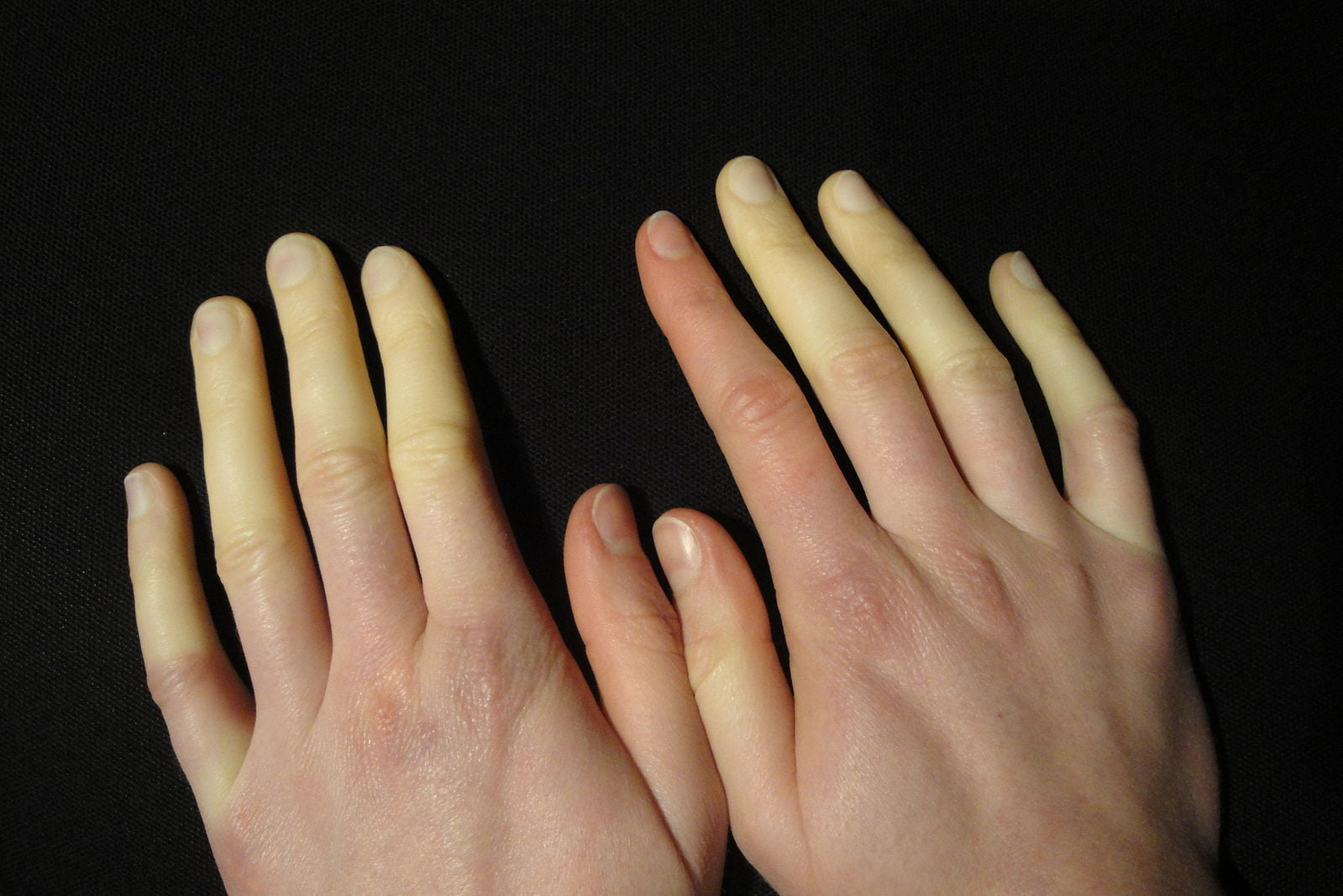 50-facts-about-raynaud-syndrome