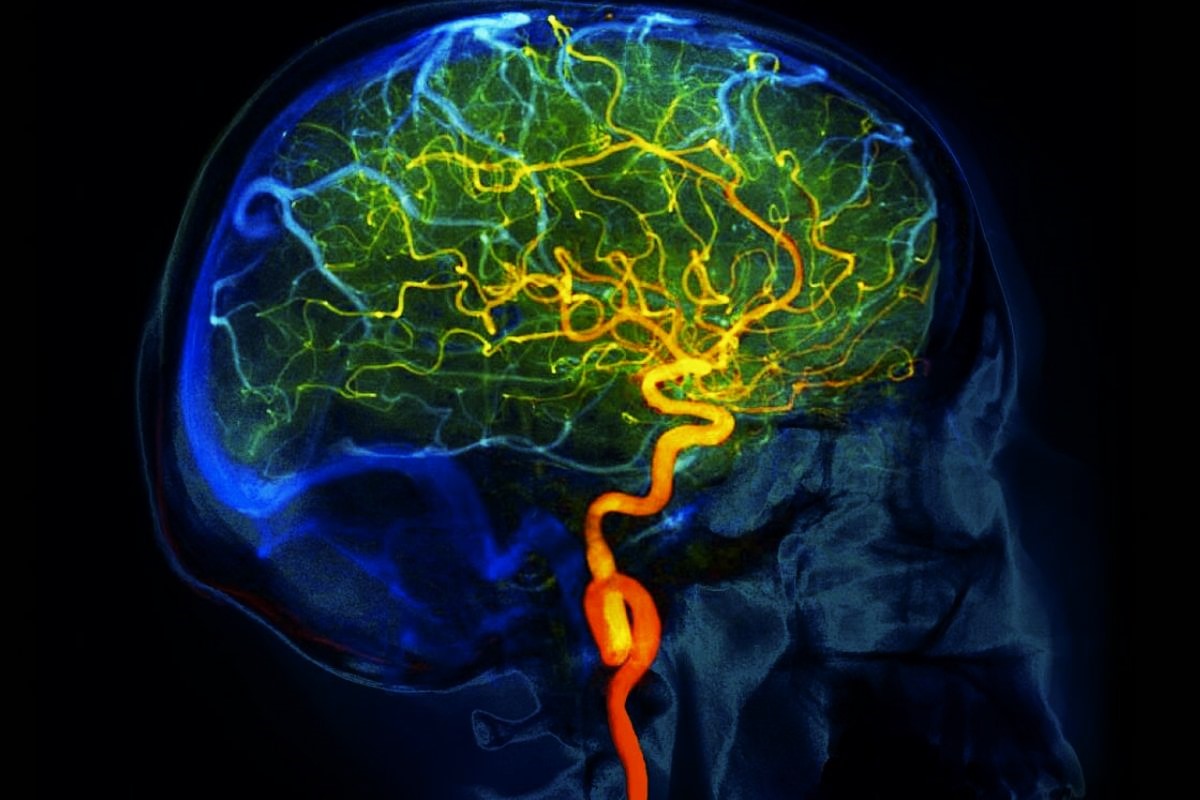 50-facts-about-reversible-cerebral-vasoconstriction-syndrome