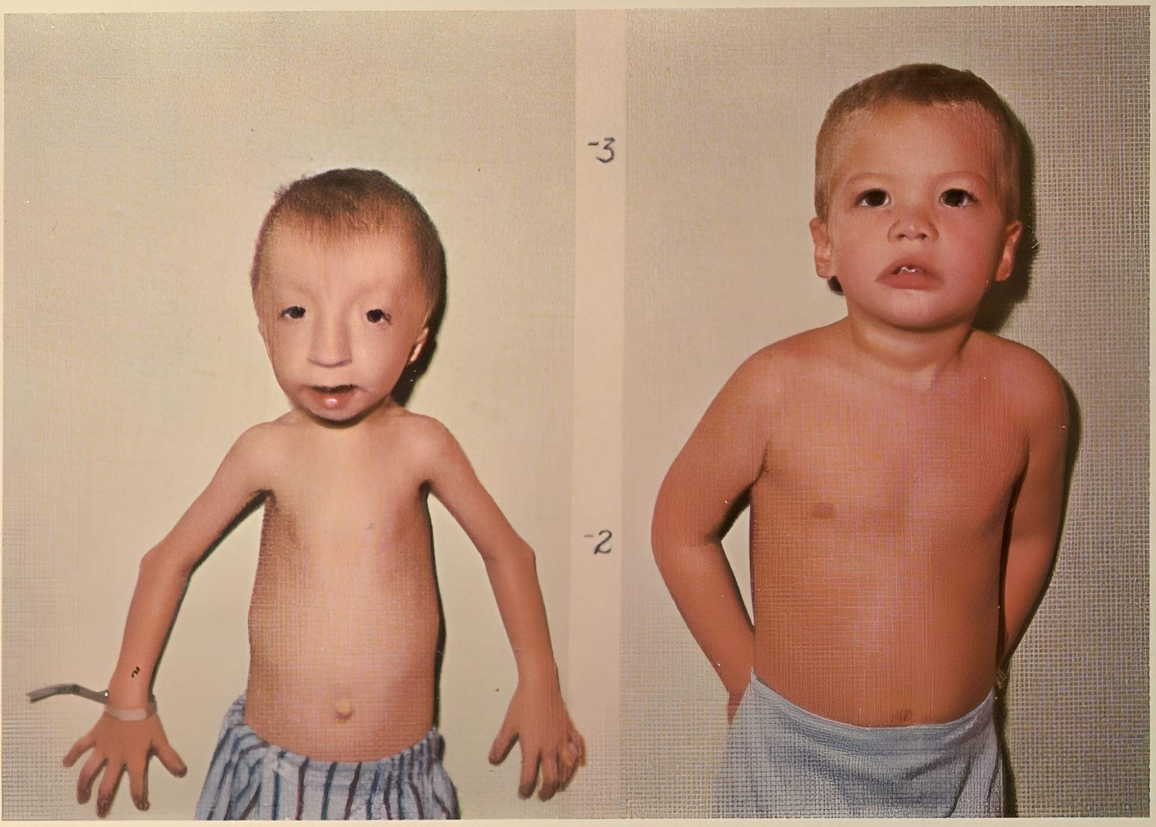 50-facts-about-seckel-syndrome