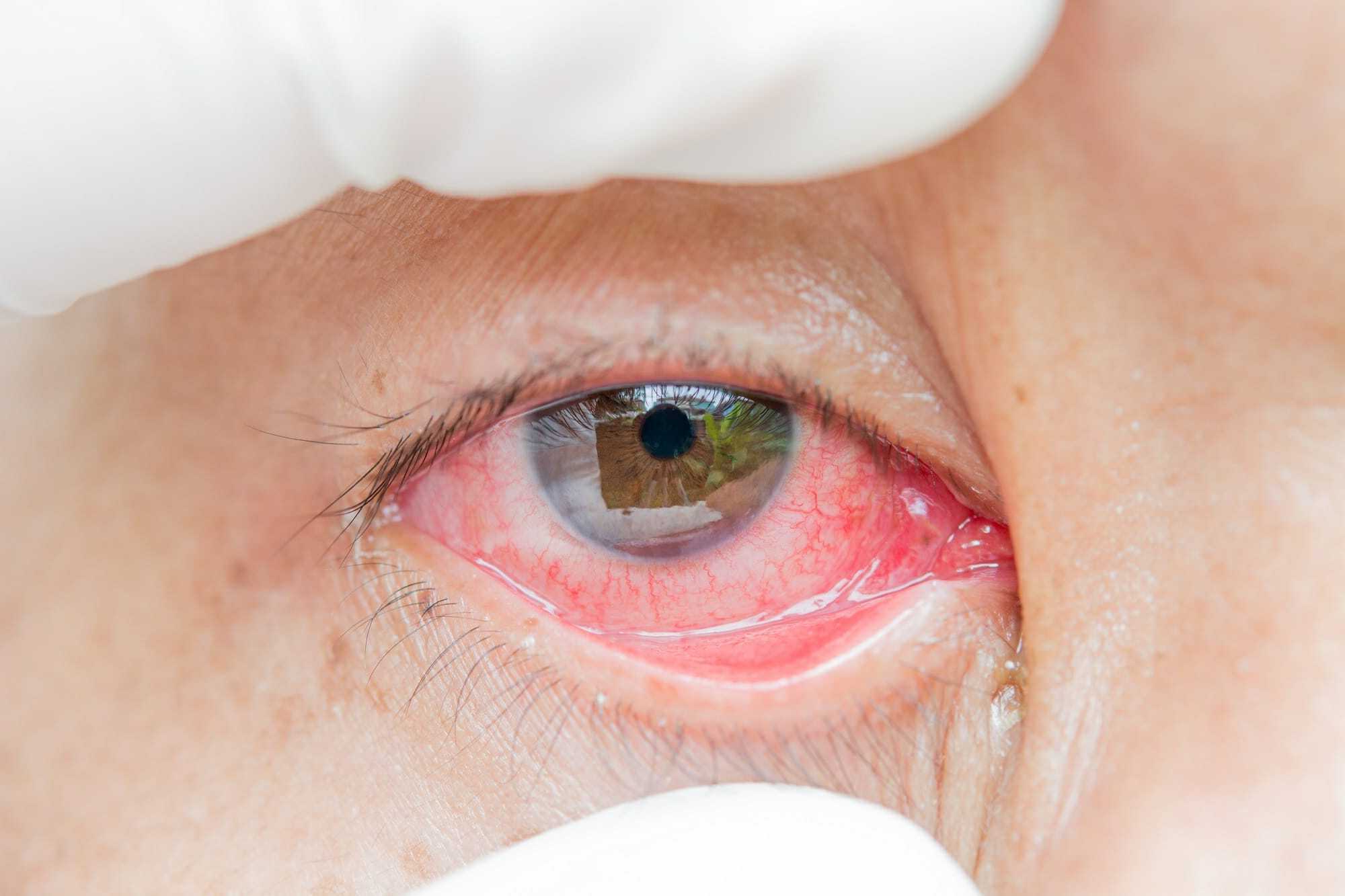 50-facts-about-sjogrens-syndrome