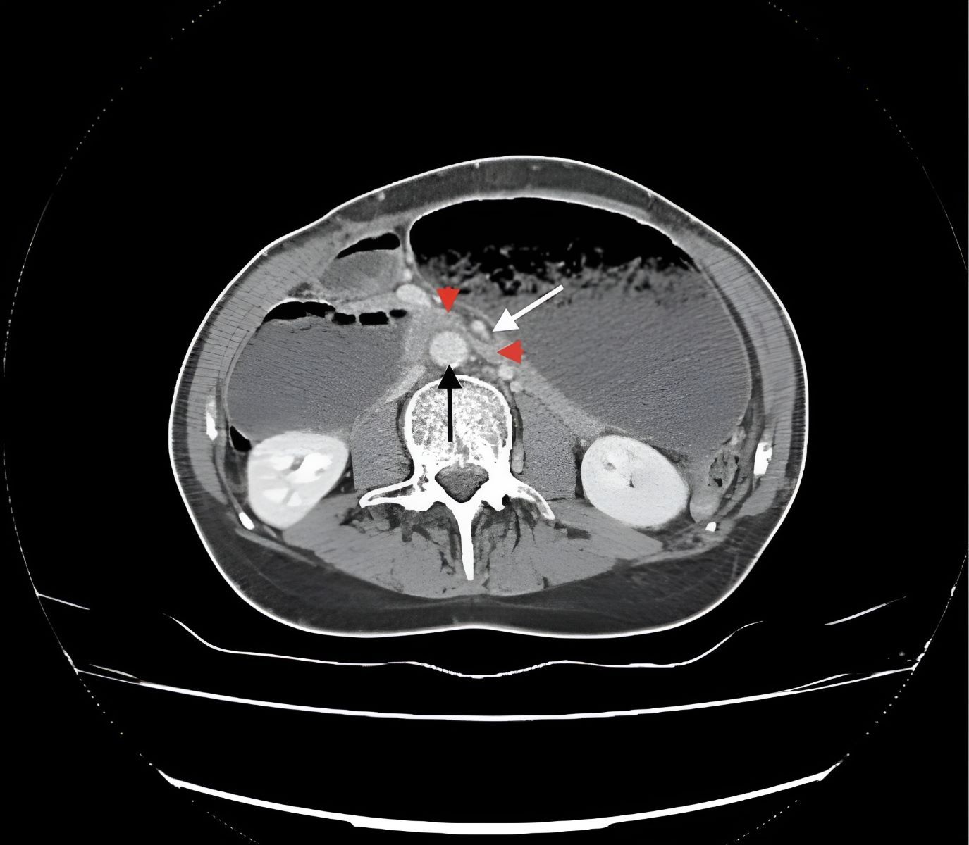 50-facts-about-superior-mesenteric-artery-syndrome