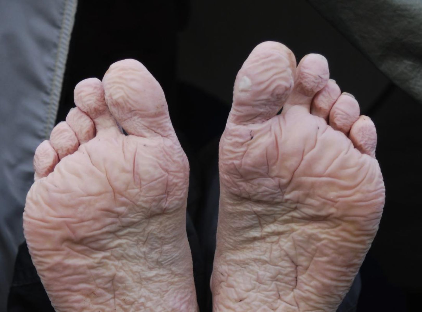 50-facts-about-trench-foot