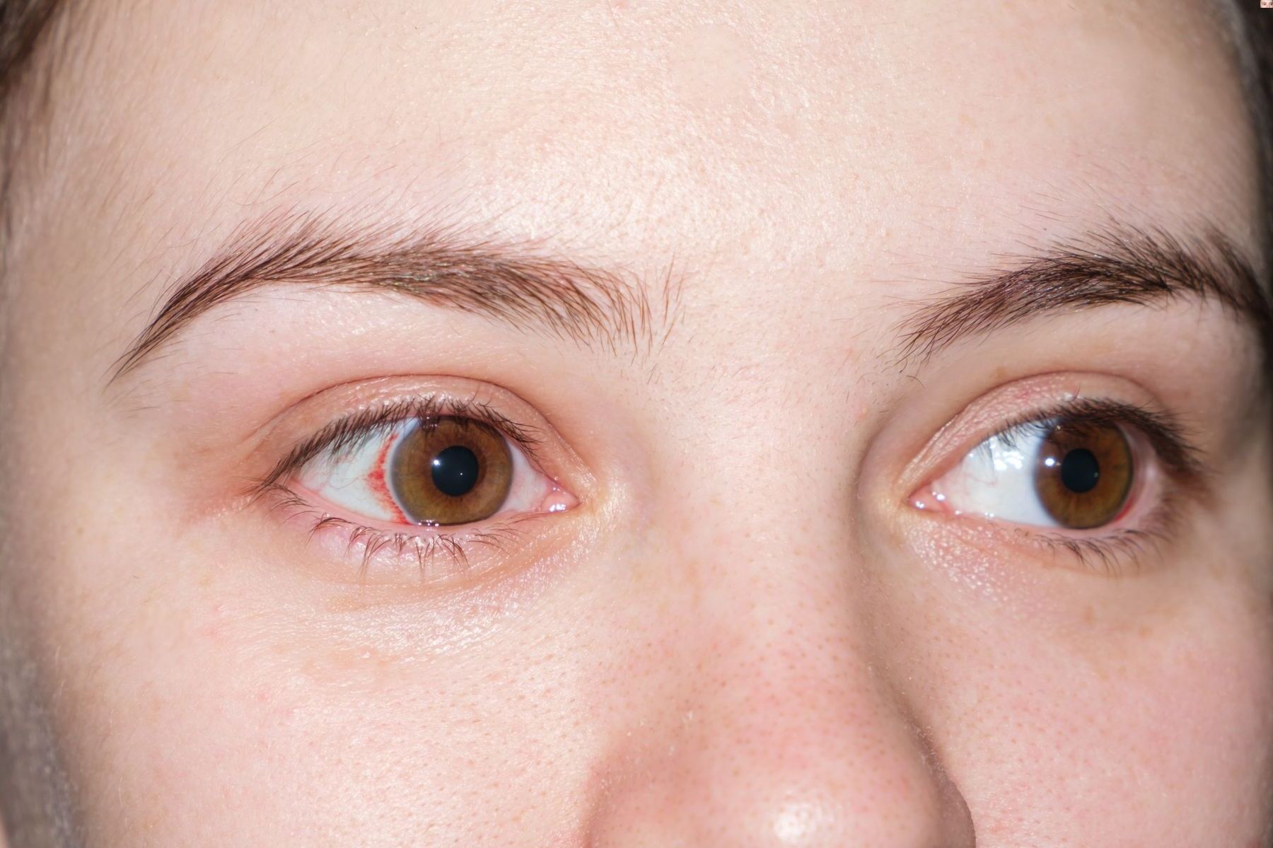 50-facts-about-xerophthalmia