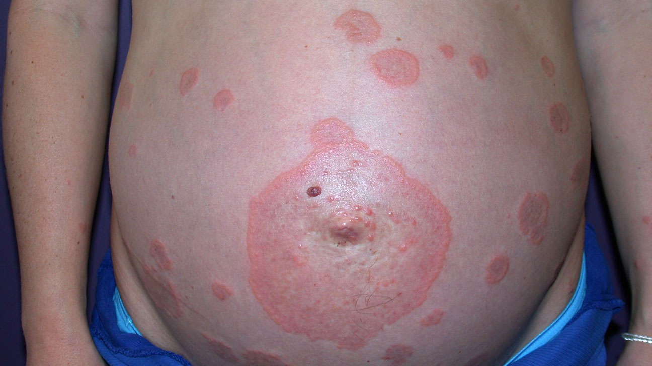 20-facts-about-gestational-pemphigoid