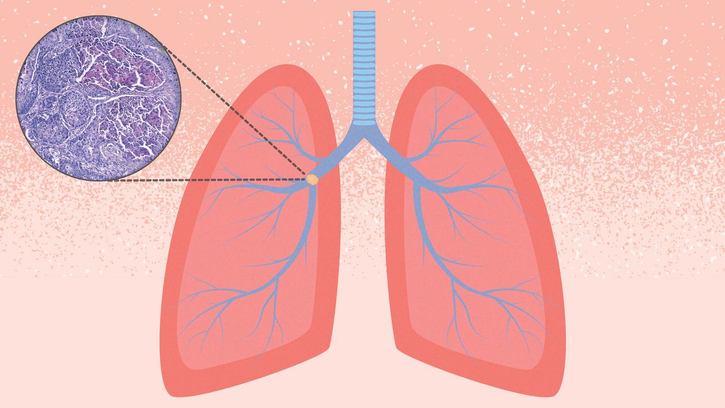 25-facts-about-basaloid-squamous-cell-lung-carcinoma