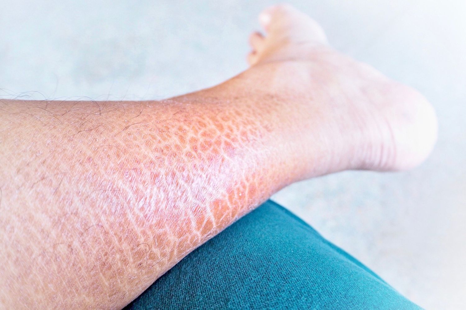 25-facts-about-dominant-ichthyosis-vulgaris