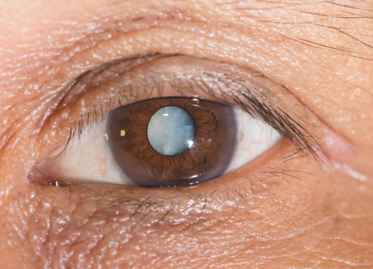 25-facts-about-dominant-zonular-cataract