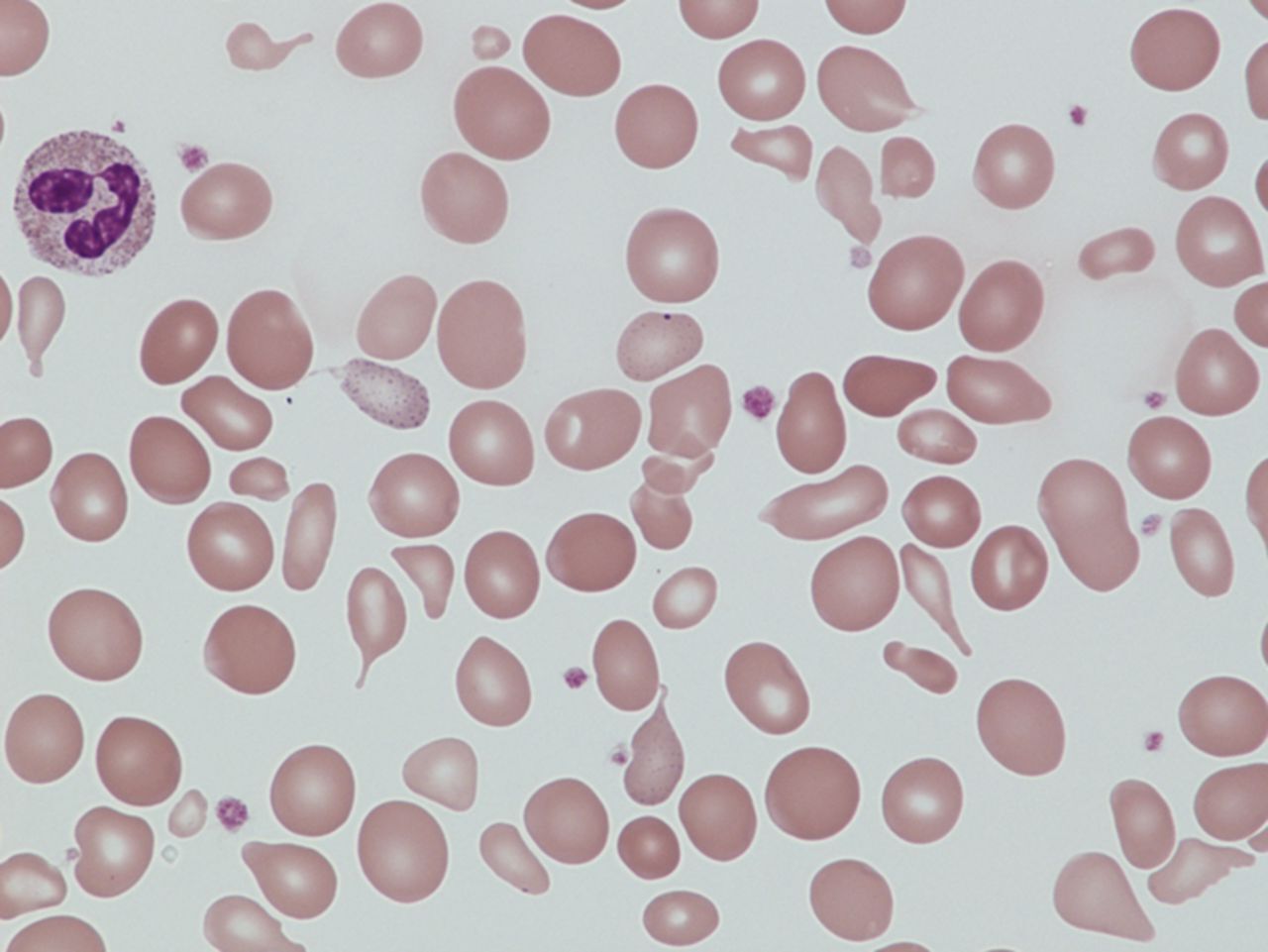 25-facts-about-dyserythropoietic-anemia