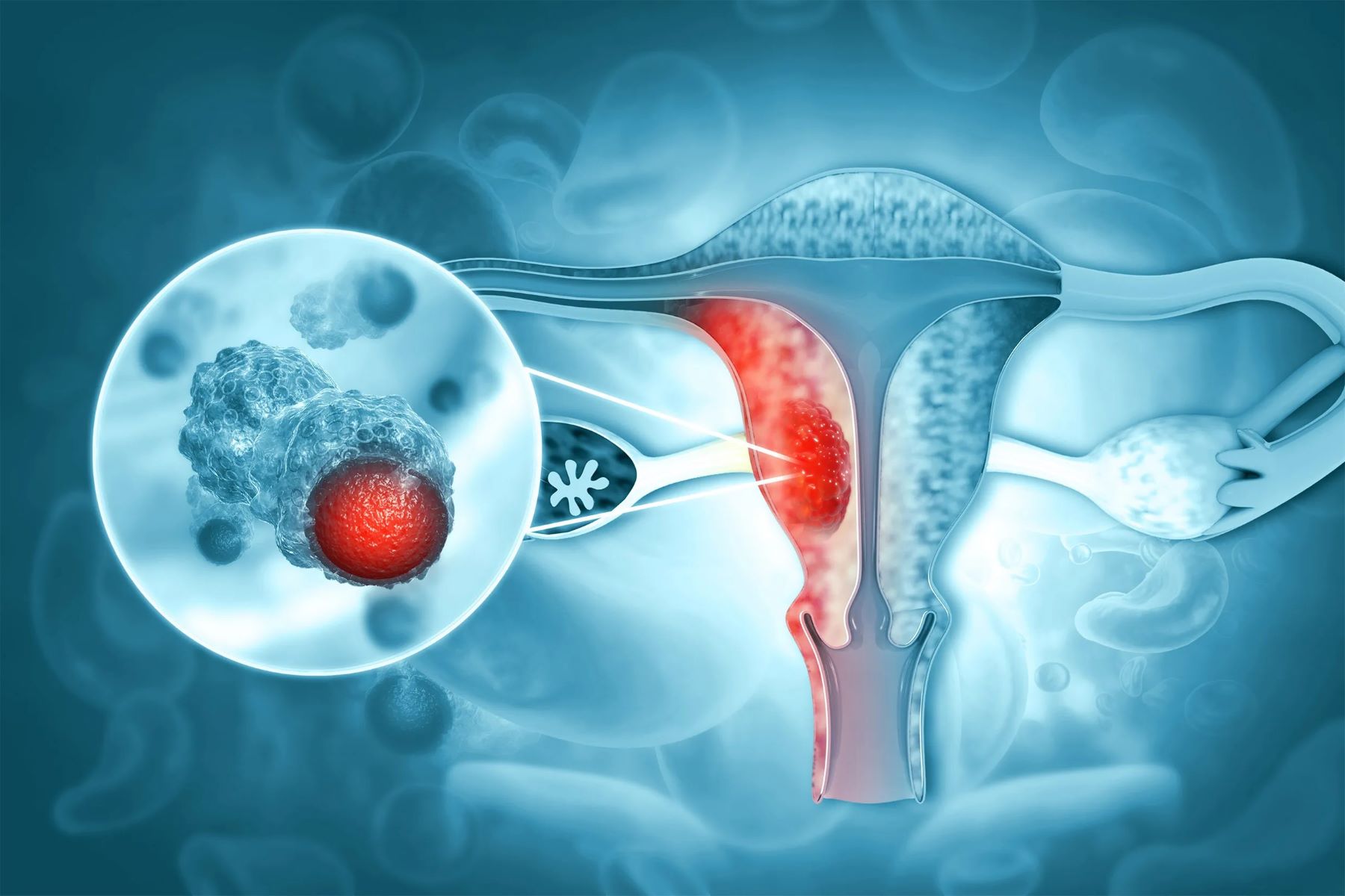 25-facts-about-endometrial-cancer-uterine-cancer