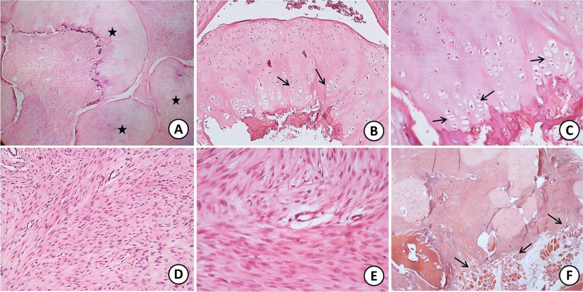 25-facts-about-fibrocartilaginous-mesenchymoma-of-bone