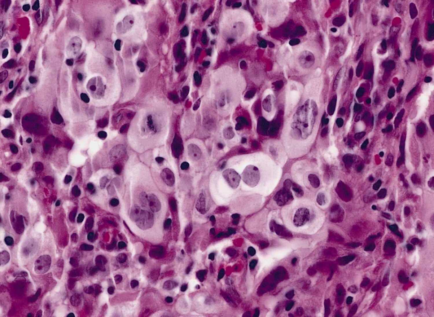 25-facts-about-giant-cell-carcinoma-of-the-lung