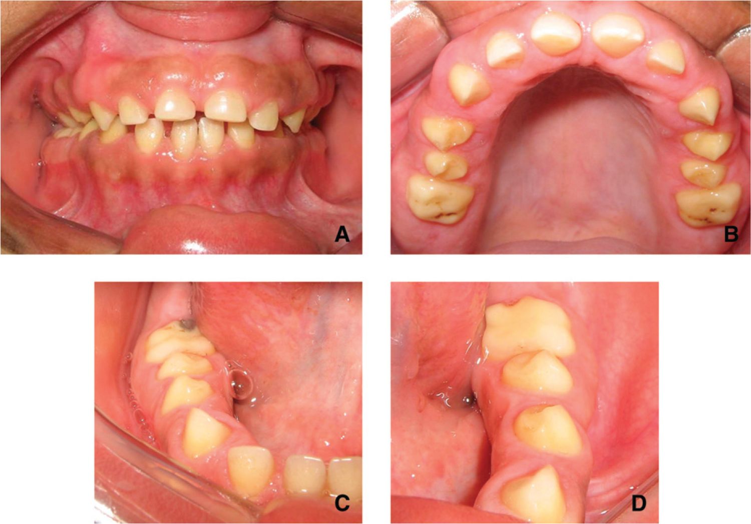 25-facts-about-gingival-fibromatosis-dominant