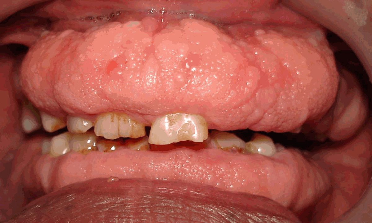 25-facts-about-gingival-fibromatosis-facial-dysmorphism