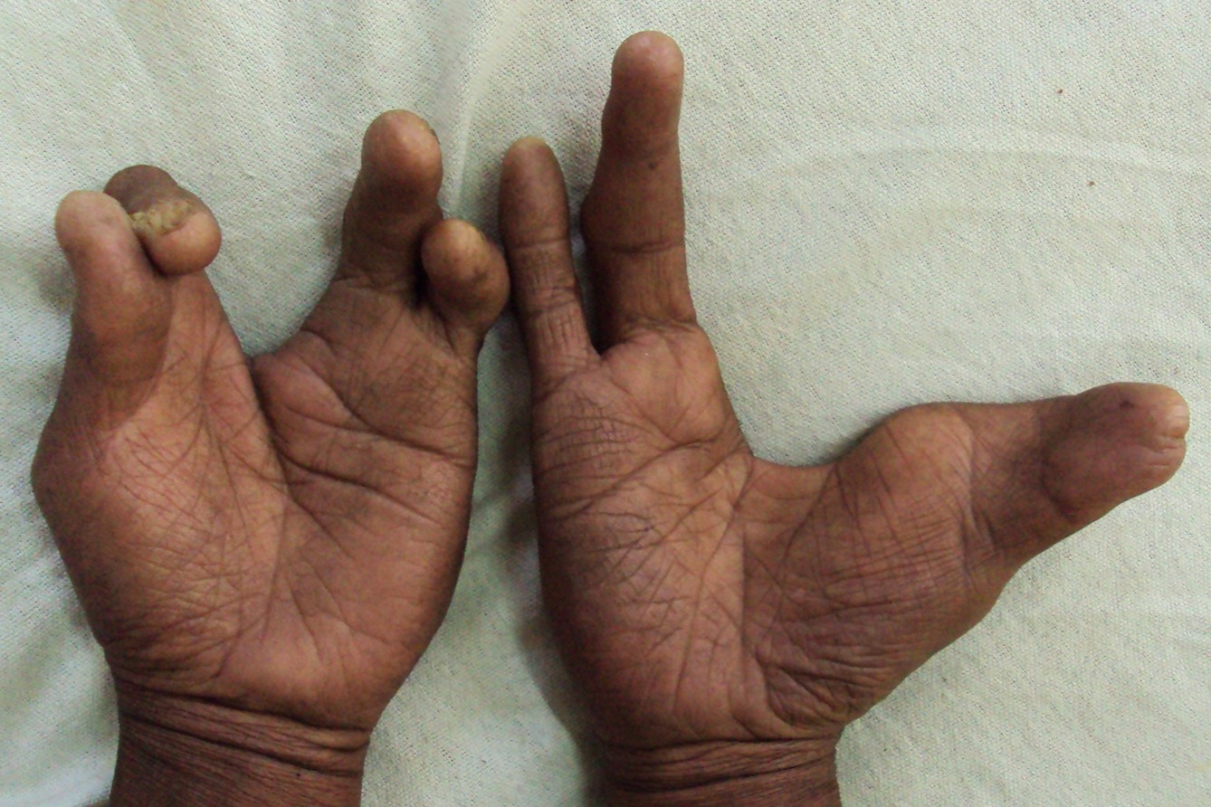 25-facts-about-hydrops-ectrodactyly-syndactyly