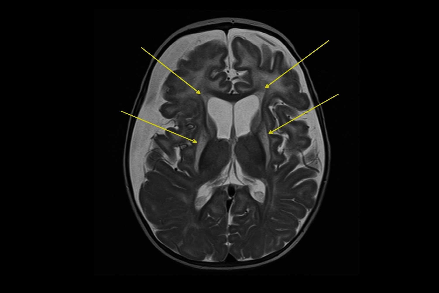 25-facts-about-hydroxymethylglutaric-aciduria