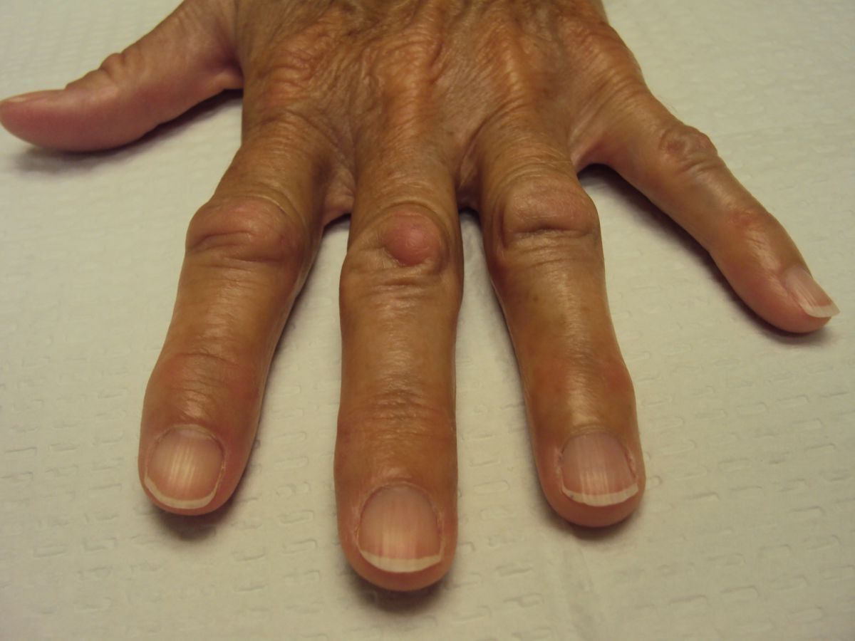 25-facts-about-knuckle-pads-disease