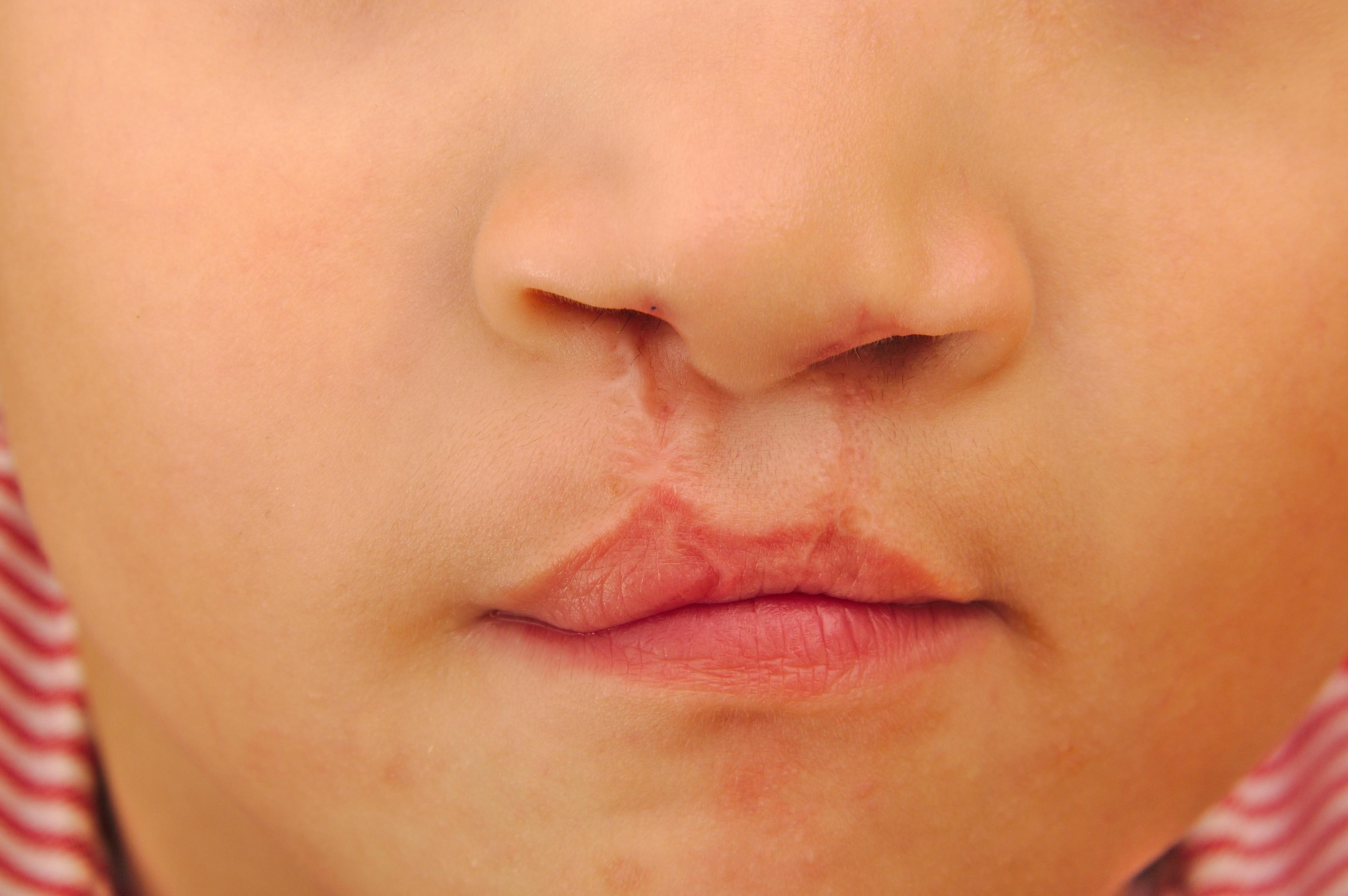 25-facts-about-lagophthalmia-cleft-lip-palate