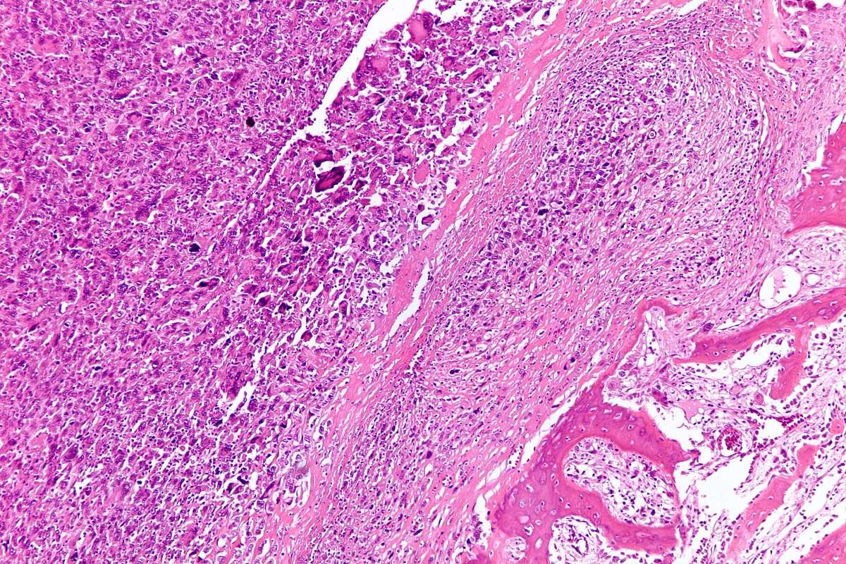 25-facts-about-malignant-fibrous-histiocytoma-of-bone-osteosarcoma