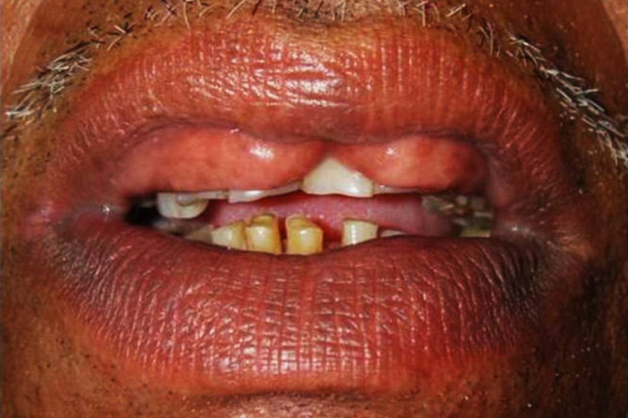 25-facts-about-maxillary-double-lip