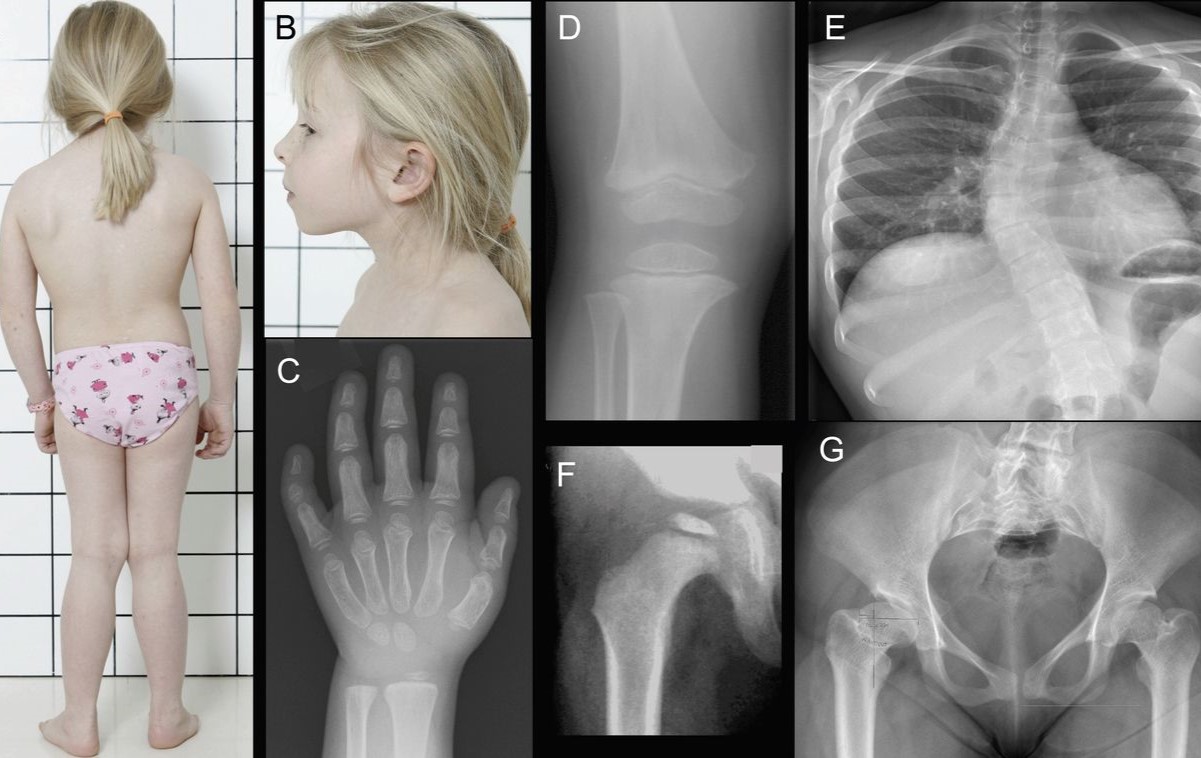 25-facts-about-mckusick-type-metaphyseal-chondrodysplasia