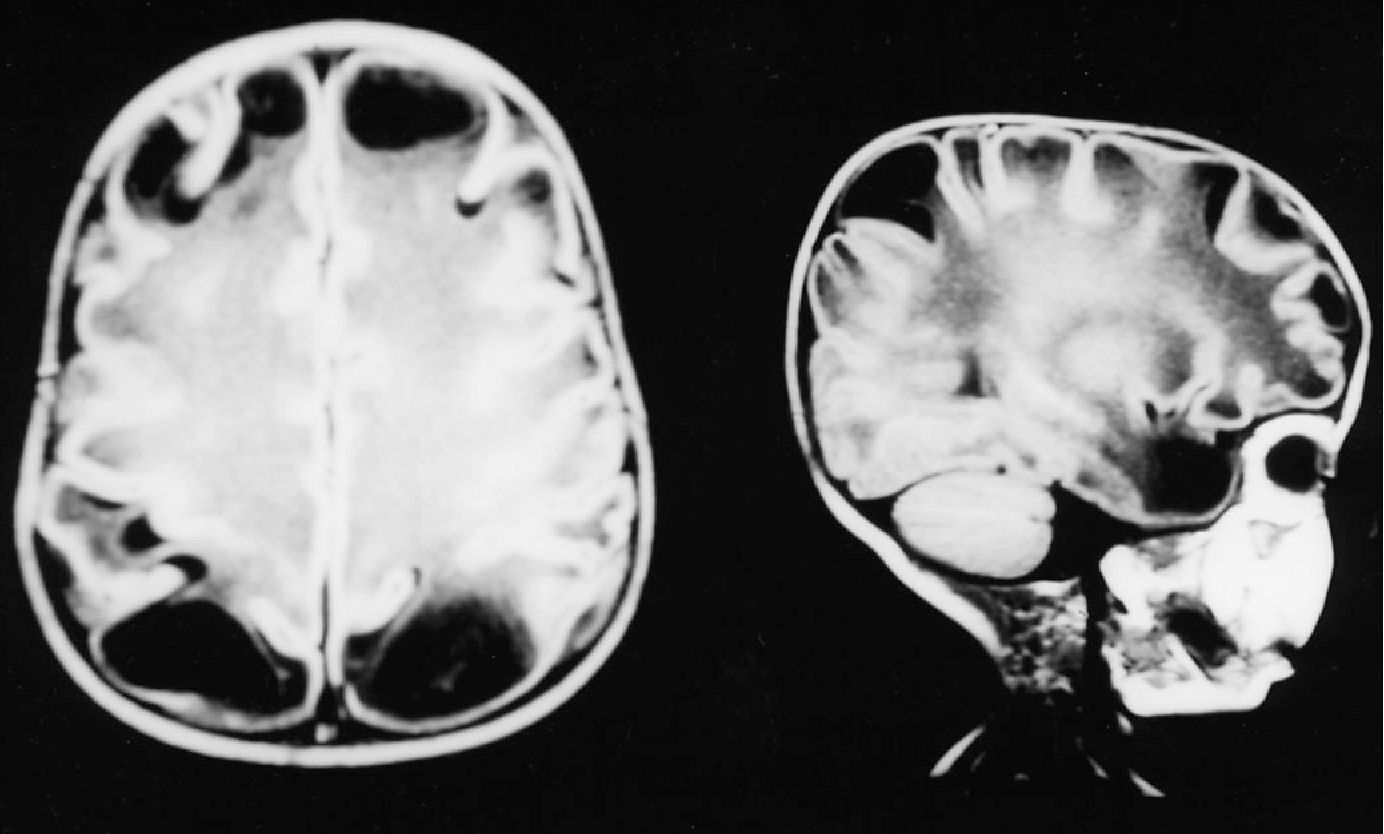 25-facts-about-megalencephaly-cystic-leukodystrophy