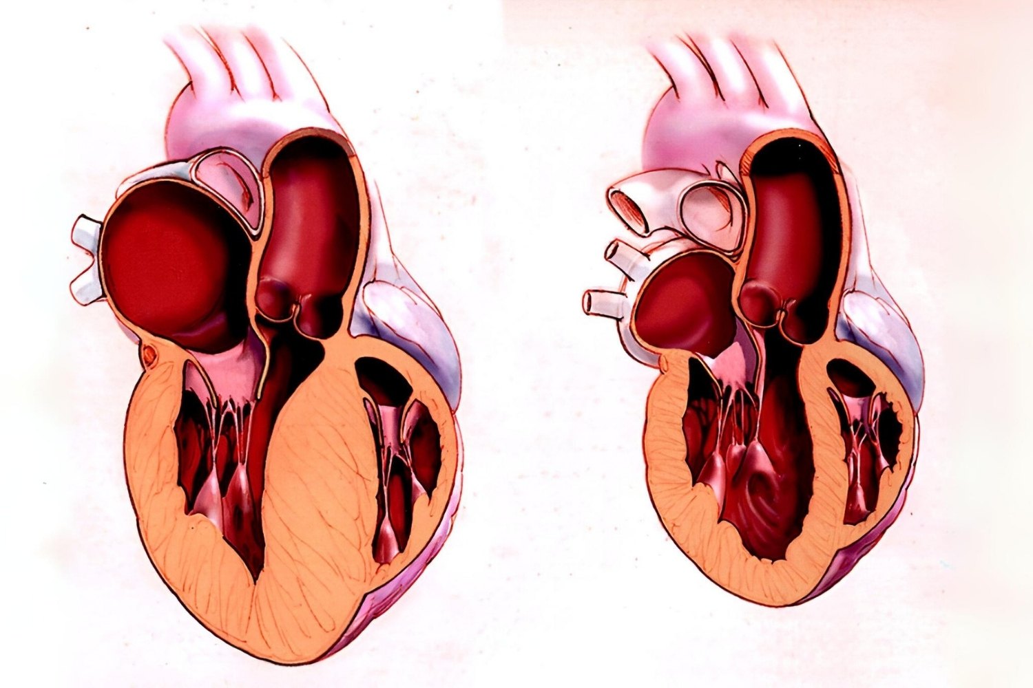 25-facts-about-obstructive-asymmetric-septal-hypertrophy