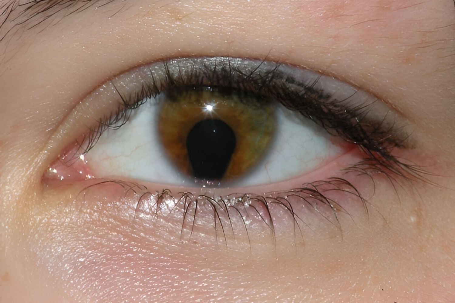 25-facts-about-ocular-coloboma-imperforate-anus