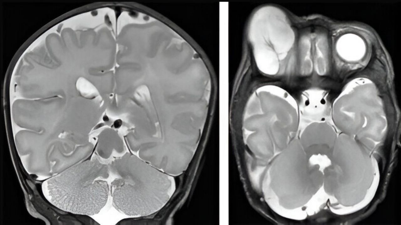 25-facts-about-oculo-cerebro-acral