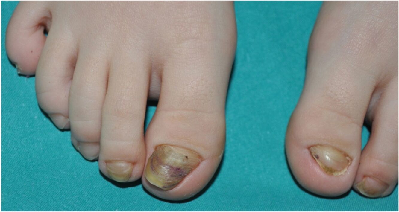 25-facts-about-onychonychia-hypoplastic-distal-phalanges