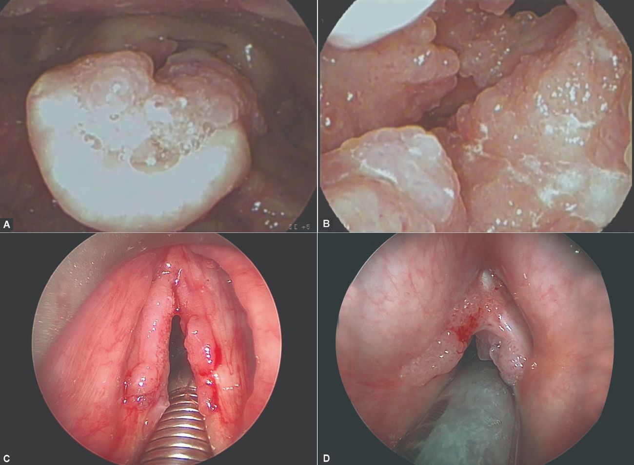 25-facts-about-papillomatosis-childhood-laryngeal