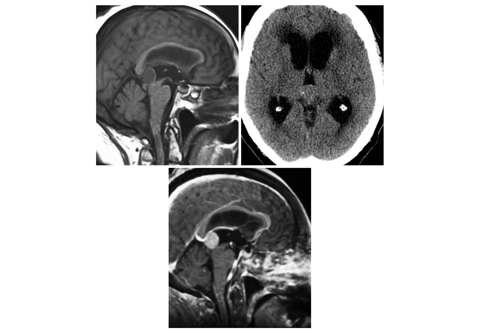 25-facts-about-pineal-astrocytoma