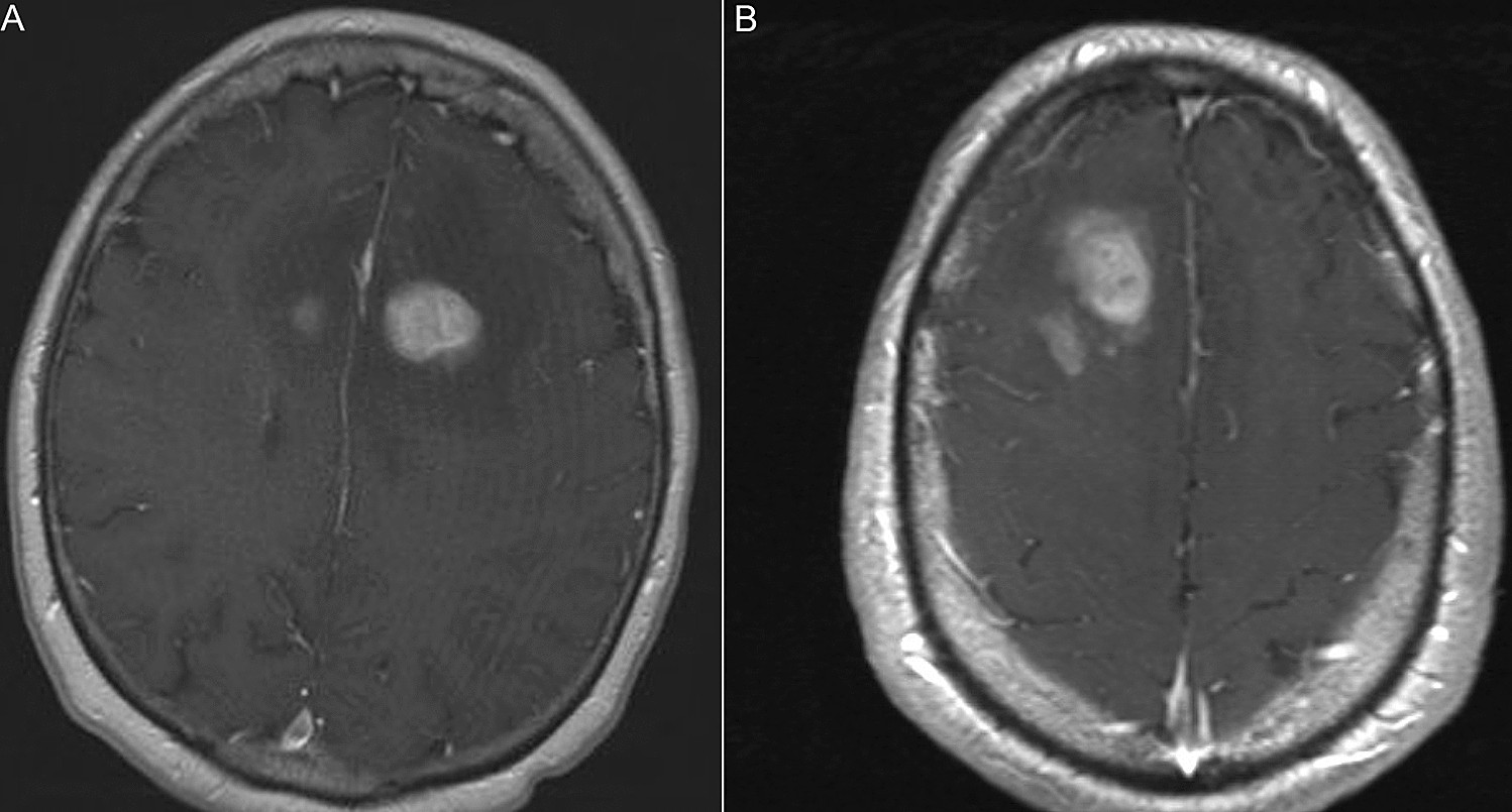 25-facts-about-primary-central-nervous-system-cns-lymphoma