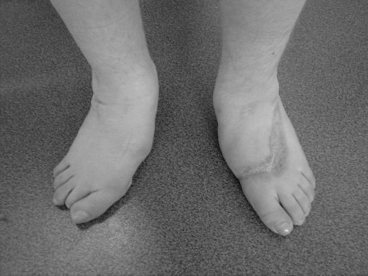 25-facts-about-thevenard-syndrome