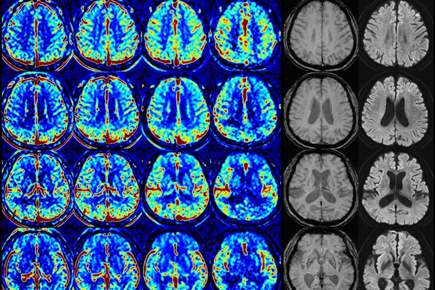 25-facts-about-total-anterior-circulation-infarct