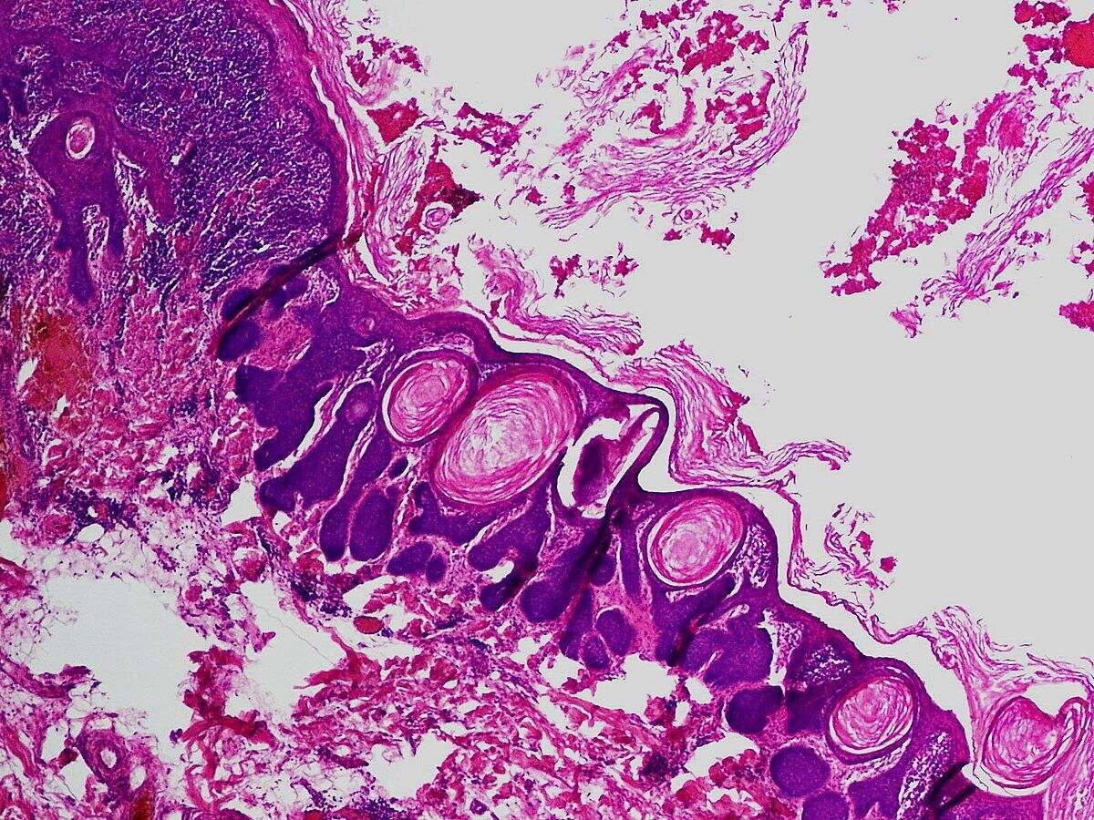 25-facts-about-trichofolliculloma