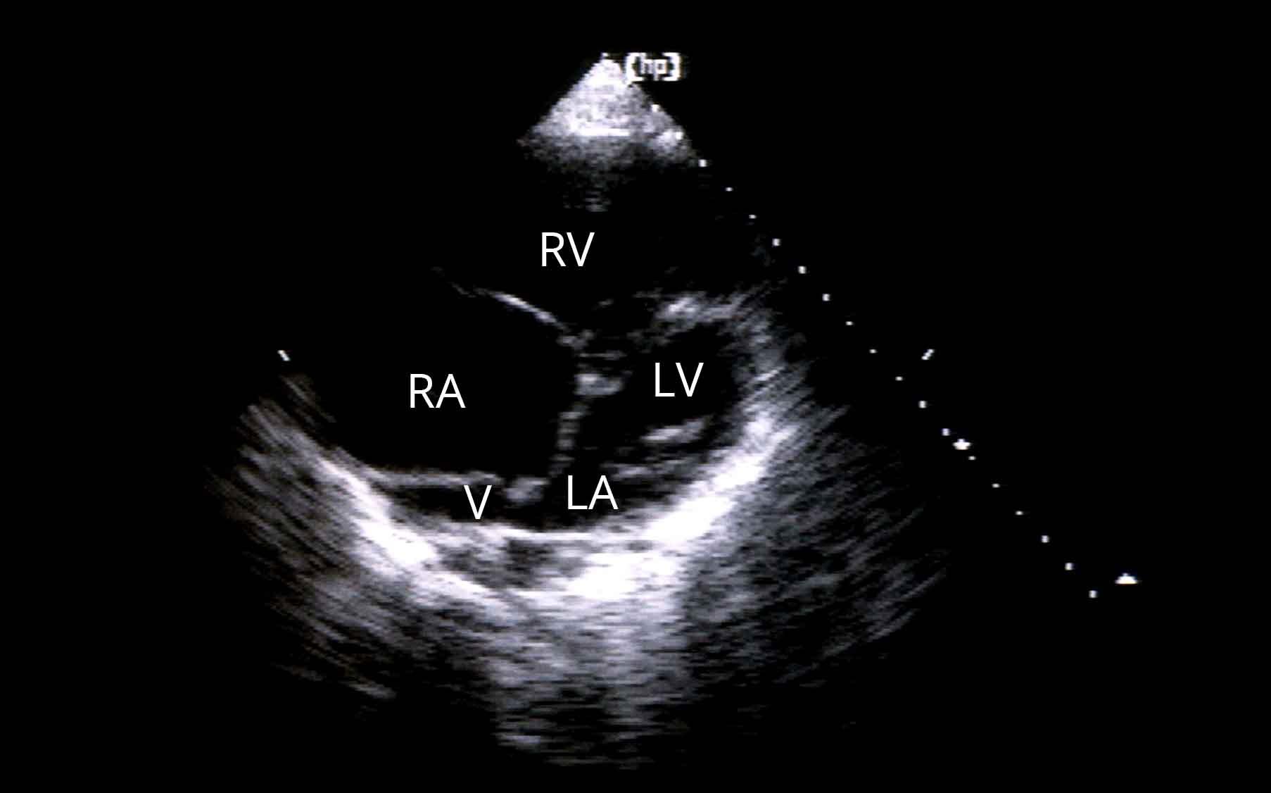 25-facts-about-ventriculo-arterial-discordance