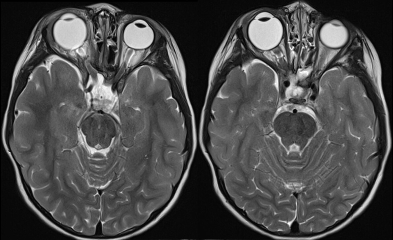 25-facts-about-visual-pathway-and-hypothalamic-glioma