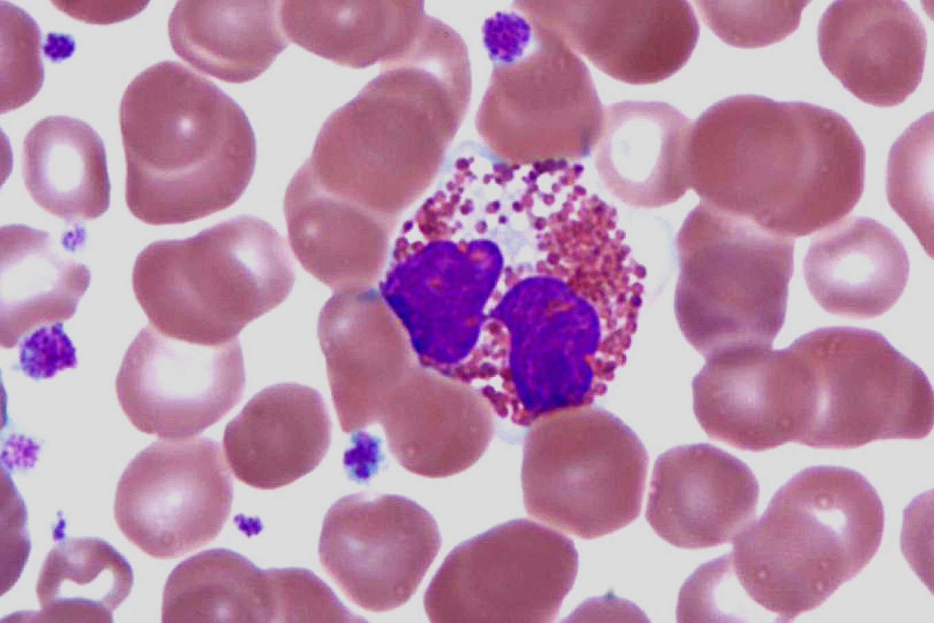 30-facts-about-acute-eosinophilic-leukemia