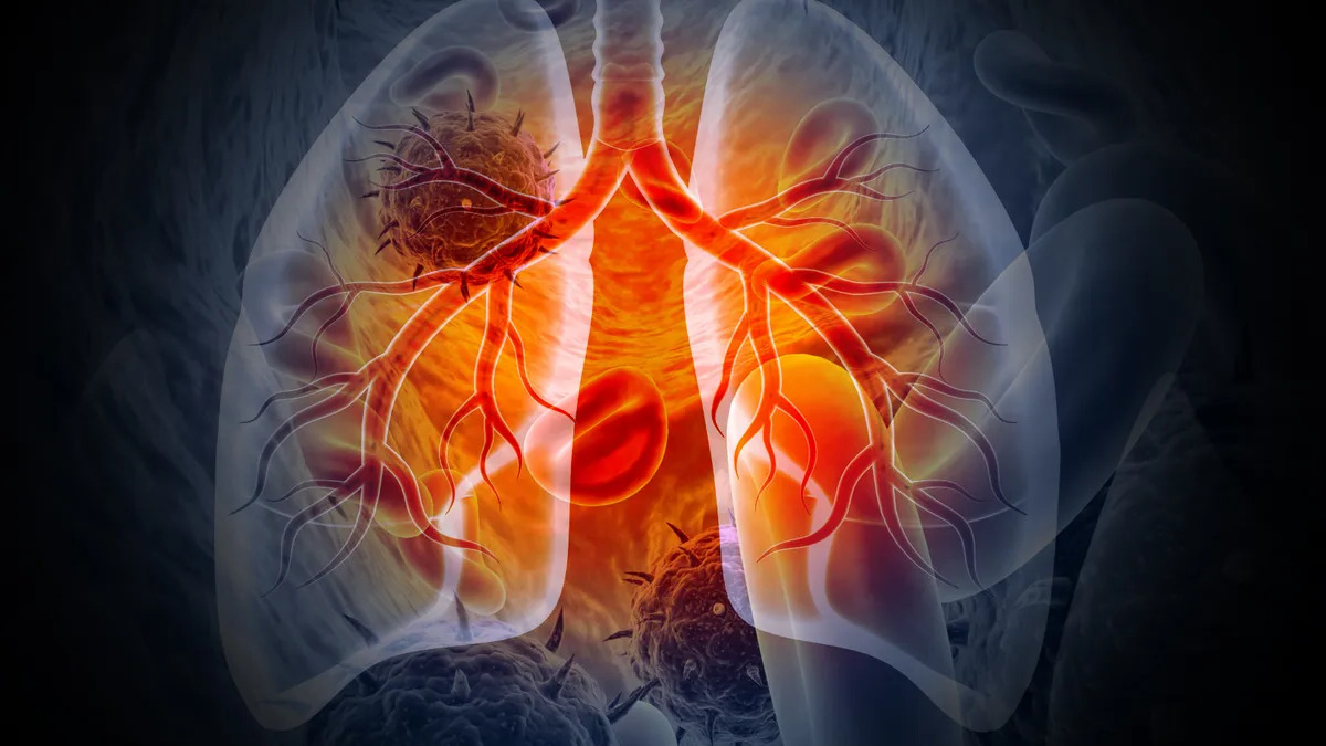 30-facts-about-bronchial-tumors-lung-cancer