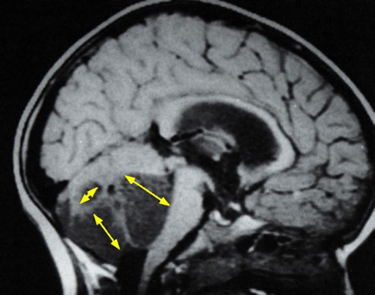 30-facts-about-cerebellar-astrocytoma