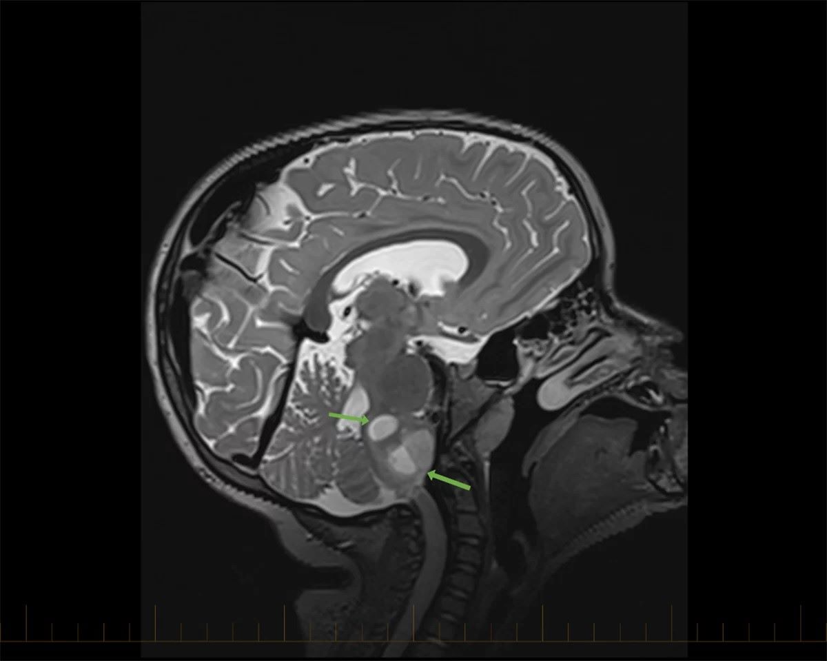 30-facts-about-cerebral-astrocytoma