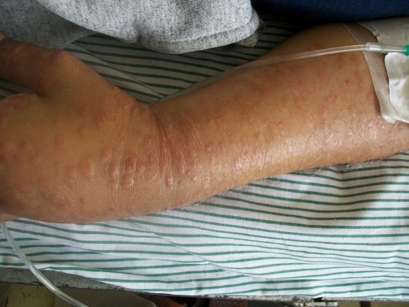 30-facts-about-cutaneous-t-cell-lymphoma-lymphoma