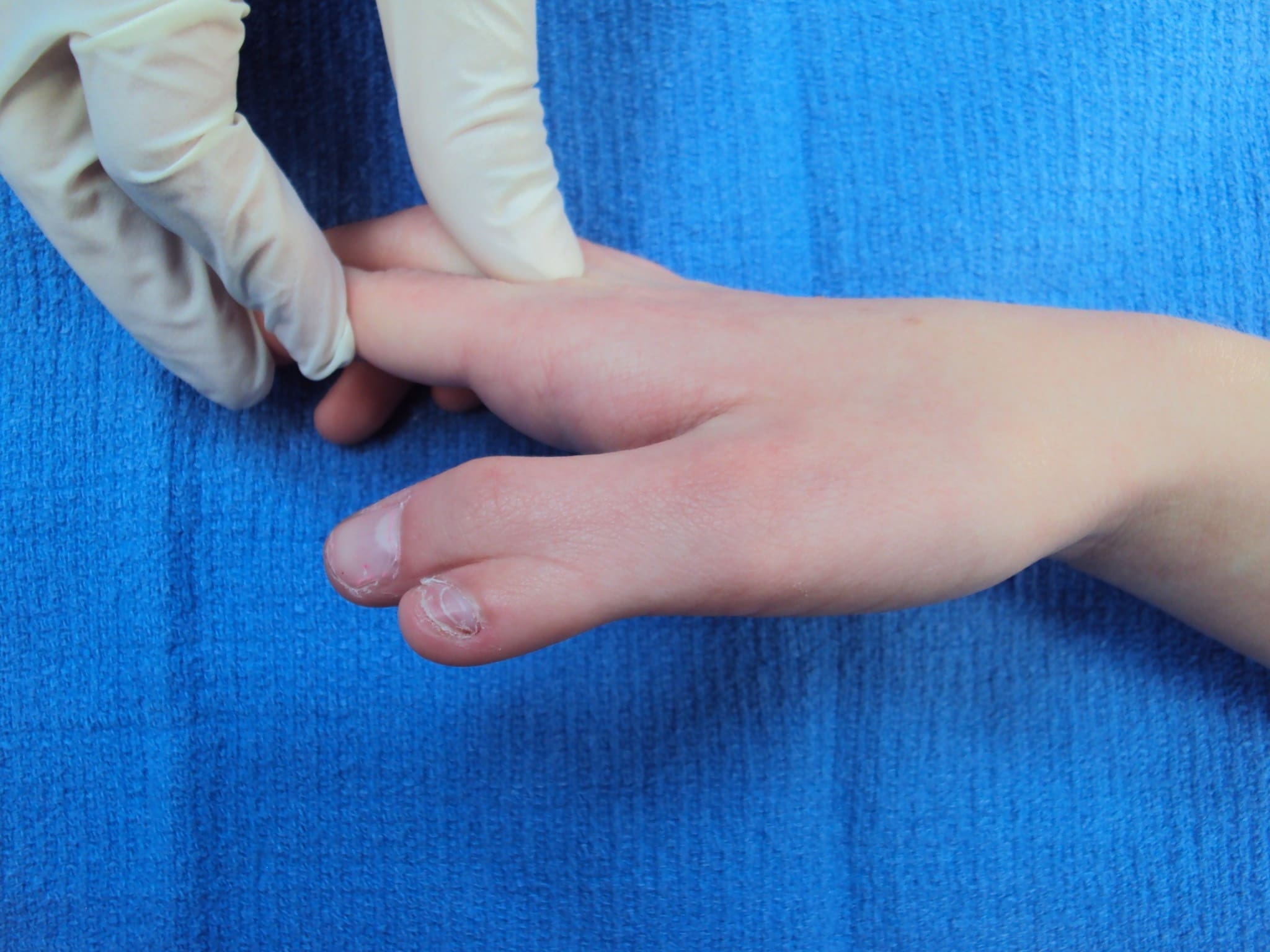 30-facts-about-duplication-of-the-thumb-unilateral-biphalangeal