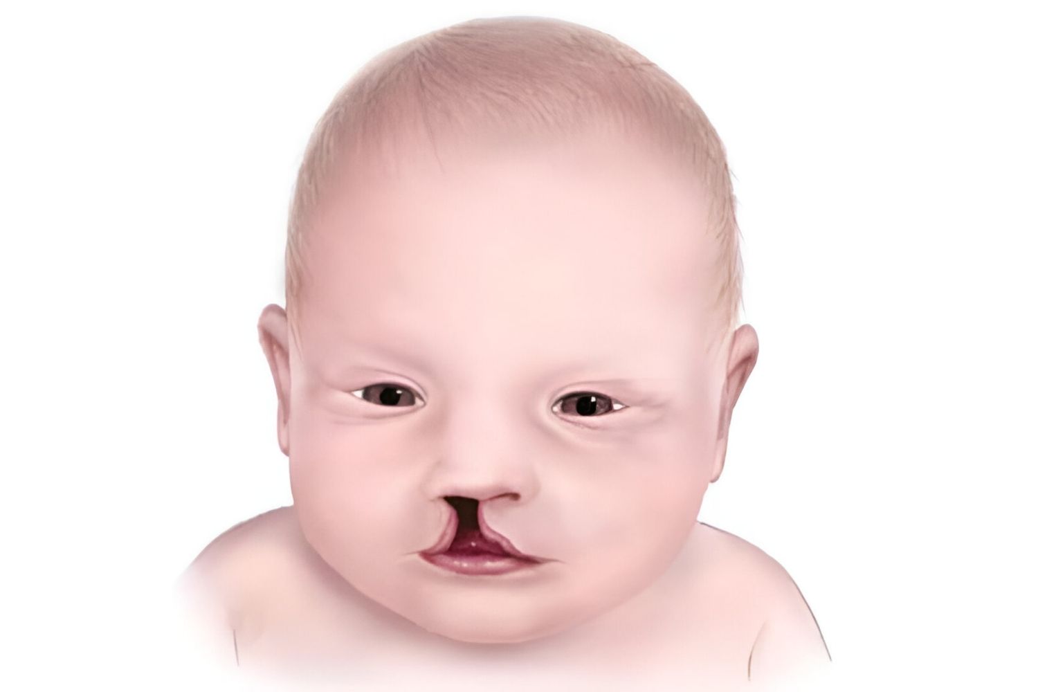 30-facts-about-dysraphism-cleft-lip-palate-limb-reduction-defects