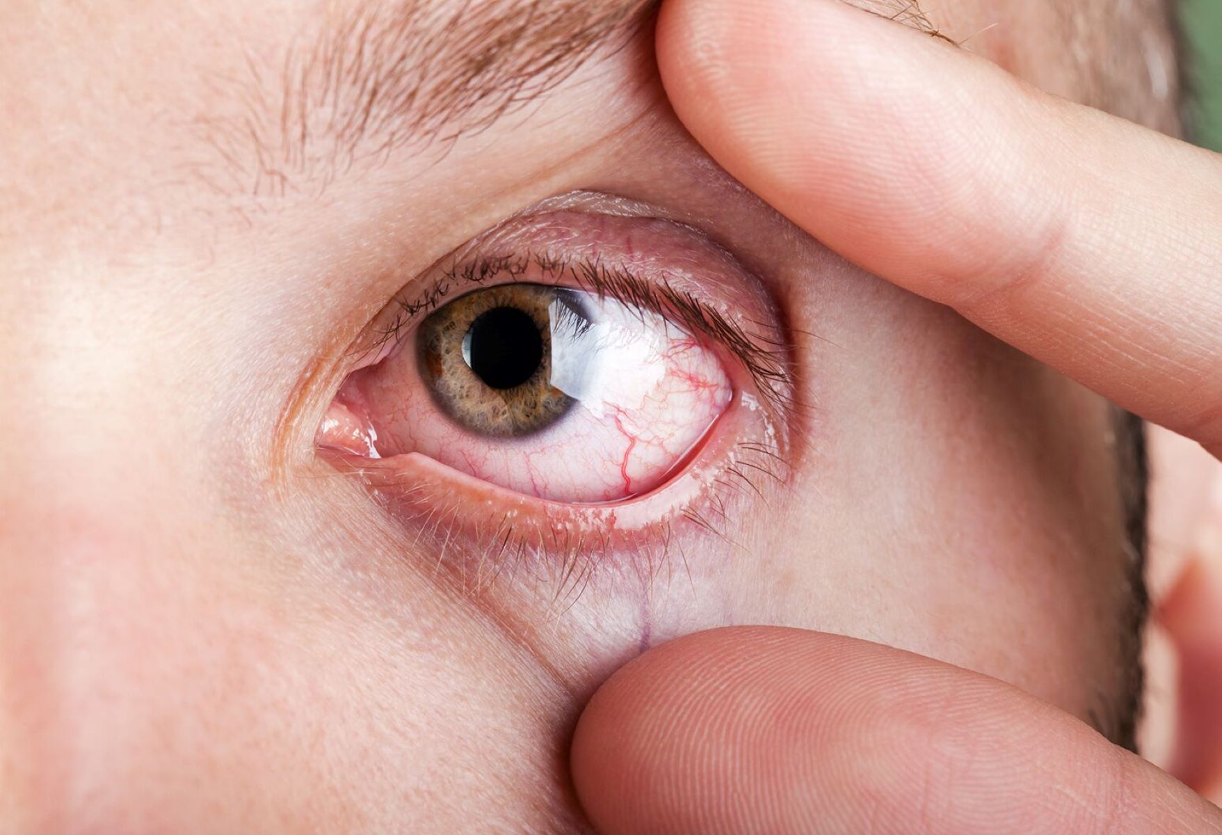 30-facts-about-eye-defects-arachnodactyly-cardiopathy